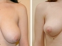 Dr. Nadia Afridi, New York City Breast Lifts