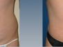 Dr. Troy Andreasen: Before and After Tummy Tuck Photos