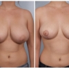 Paradise Valley Breast Reduction, Dr. Robert Cohen 2