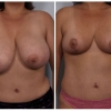 Paradise Valley Breast Reduction, Dr. Robert Cohen 9