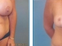 Dr. Anthony Deboni: Tummy Tuck Results