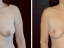 Dr. Miguel Delgado, San Francisco Breast Lifts