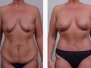 Dr. Gustavo Galante:  Before and After Abdominoplasty Photos