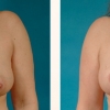Grand Rapids Breast Reduction, Partners in Plastic Surgery of West Michigan 1