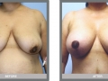 San Diego Breast Lifts