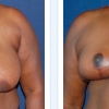 Round Rock Breast Reduction, Dr. Mahlon Kerr 10