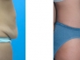 Dr. LoVerme: Before and After Abdominoplasty