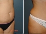 Tummy Tuck Before and After by Dr. Marc Malek