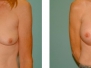 Dr. Jeffrey Poulter, Peoria Breast Reconstruction