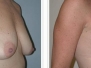 Dr. Jeffrey Rockmore, Albany Breast Lifts