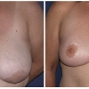 Birmingham Michigan Breast Reduction, Dr. William Vasileff 1