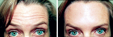 Dr. Reath, Knoxville Botox Before and After Photos