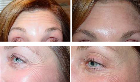 Dr. Paul Steinwald, Botox Before and After Photos