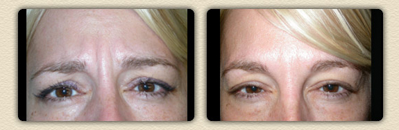 Dr. Brian Glatt, Botox Before and After
