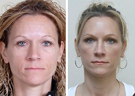 Dr. Weinberg, Botox Before and After Photo
