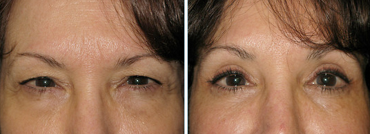 Dr. Lori Polacek, Eyelid Surgery Photos