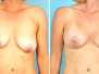 Dr. Baker: Before and After Denver Breast Lifts