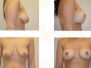 Dr. Arie Benchetrit, Montreal Breast Lifts