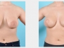 Bengtson Center: Breast Lift Photos