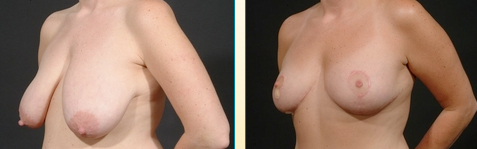 Breast Reduction Photos