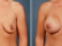 Dr. Bradley Calobrace: Breast Lifts
