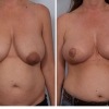 Paradise Valley Breast Reduction, Dr. Robert Cohen 1