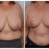 Paradise Valley Breast Reduction, Dr. Robert Cohen 6