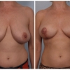 Paradise Valley Breast Reduction, Dr. Robert Cohen 7