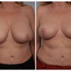 Paradise Valley Breast Reduction, Dr. Robert Cohen 8