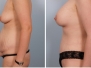 Dr. Robert Cohen, Paradise Valley Breast Lifts