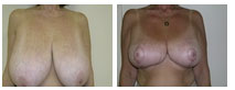 Mandeville Breast Reduction, Dr. Michele Cooper 3