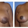 Mandeville Breast Reduction, Dr. Michele Cooper 1