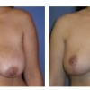 Mandeville Breast Reduction, Dr. Michele Cooper 2