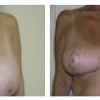 Mandeville Breast Reduction, Dr. Michele Cooper 3