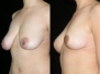 Dr. Michelle Copeland, New York City Breast Lifts