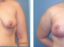 Dr. Anthony Deboni: Breast Lift with Implants