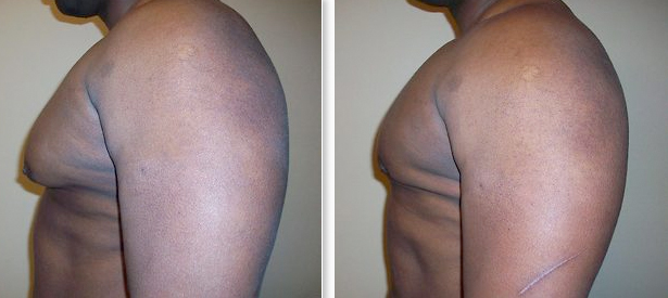 Before and After Gynecomastia