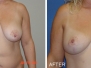 Dr. Audrey Farahmand, Fort Myers Breast Lifts