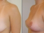 Dr. Elizabeth Fox, Naples Breast Lifts
