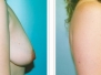 Dr. Susan Gannon, Albany Breast Lifts