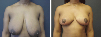 Bala Cynwyd Breast Reduction, Dr. Paul Glat 1