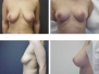 Dr. Paul Glat, Philadelphia Breast Lifts