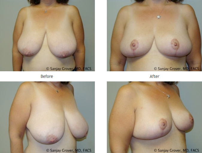 Newport Beach Breast Reduction, Dr. Sanjay Grover 1