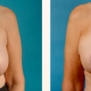 Grand Rapids Breast Reduction, Partners in Plastic Surgery of West Michigan 2