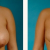 Grand Rapids Breast Reduction, Partners in Plastic Surgery of West Michigan 3