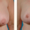 Grand Rapids Breast Reduction, Partners in Plastic Surgery of West Michigan 16