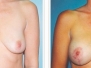 Dr. Douglas Hargrave, Albany Breast Lifts