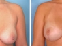 Dr. Kent Hasen, Naples Breast Lifts
