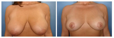 Naples Breast Reduction, Dr. Kent Hasen 1