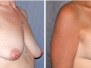 Dr. Holly Casey Wall, Shreveport Breast Lifts